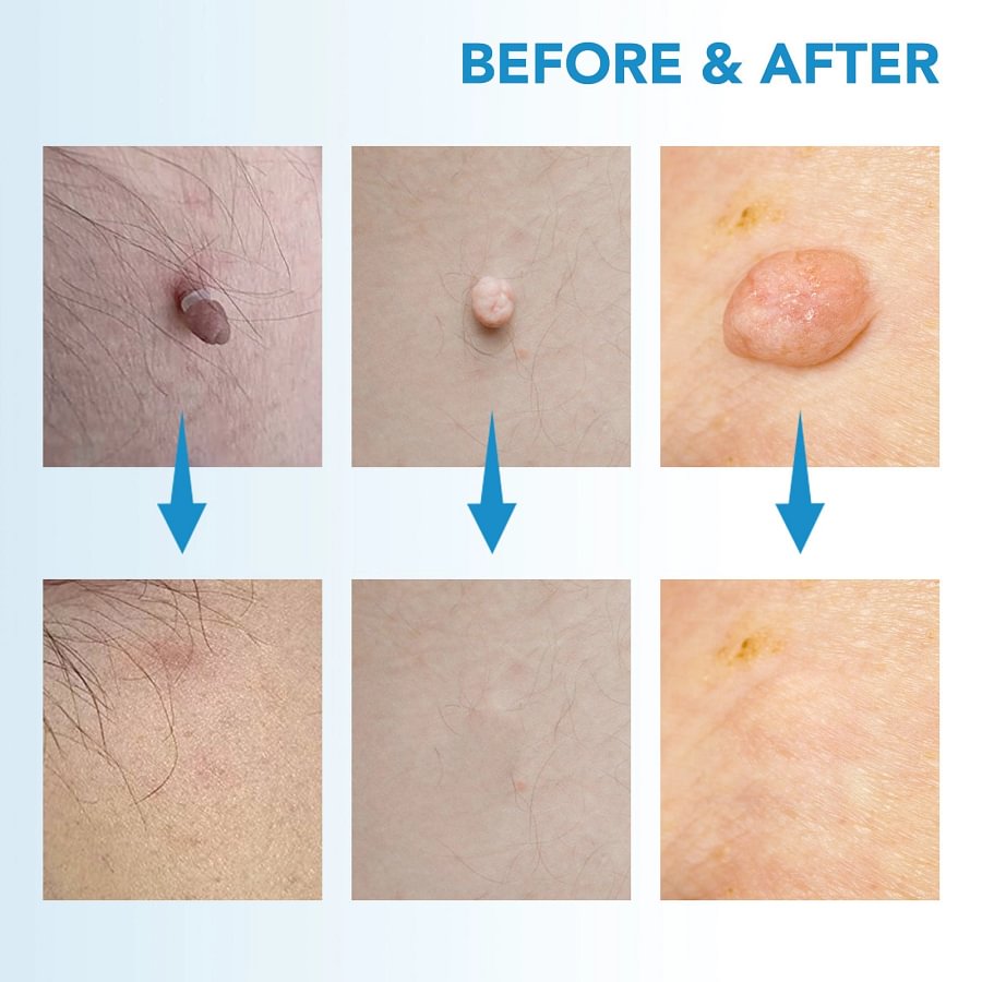 ✨ Painless Skin Tag Remover ✨ — Reveal Smooth, Clear Skin Fast! 🌿