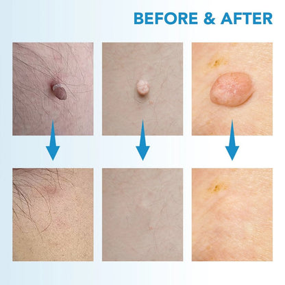 ✨ Painless Skin Tag Remover ✨ — Reveal Smooth, Clear Skin Fast! 🌿
